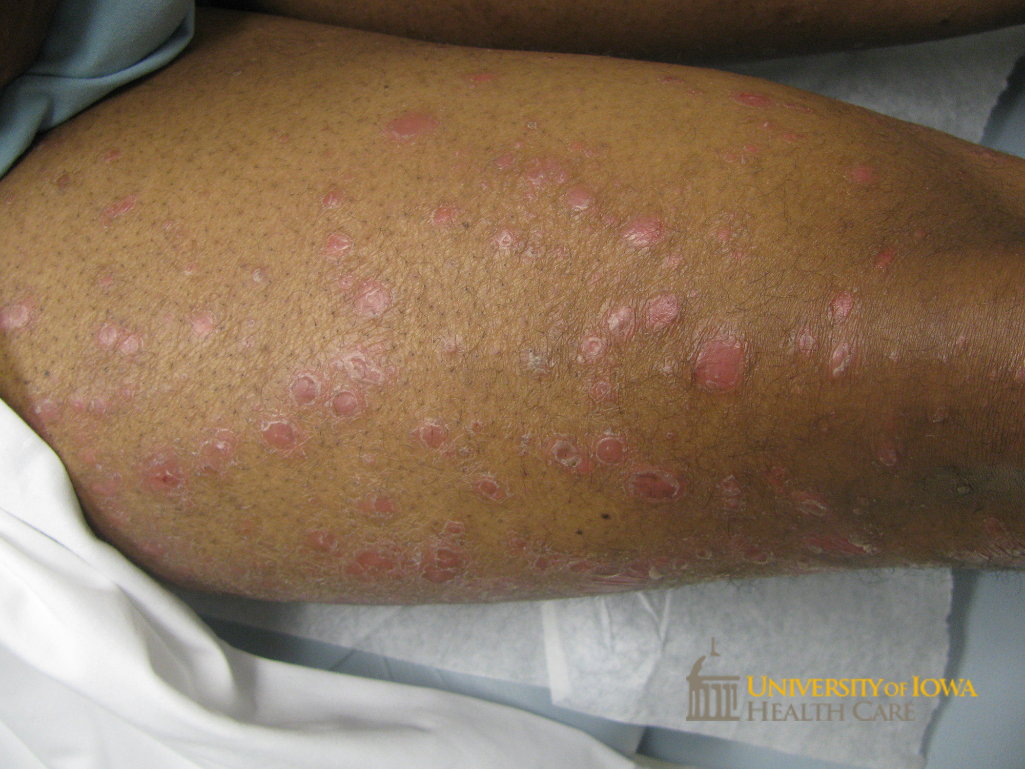 Salmon-colored papules and plaques with scale on the lower legs. (click images for higher resolution).